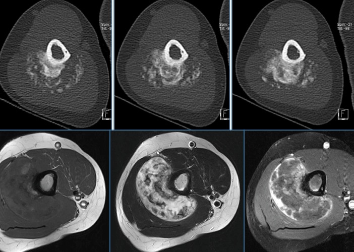 Figure 3 for case Parosteal osteosarcoma ( RID4021 )